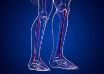 fibulakoje subluxatie