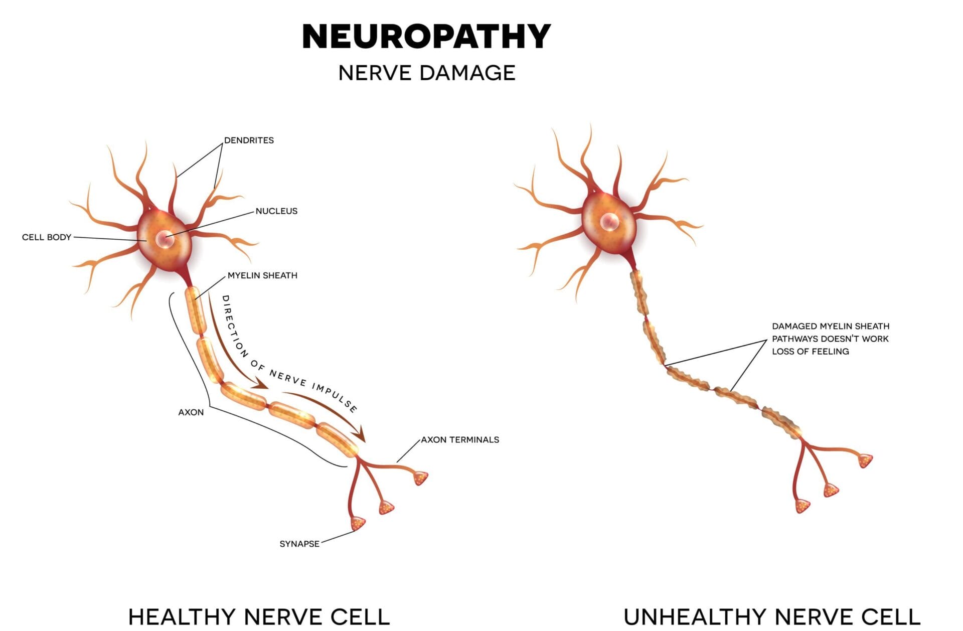 Schema van perifere neuropathie met aangedane zenuwen in de voet